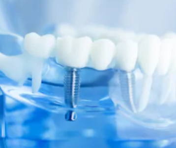 Dental Implants