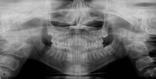 Panoramic XRAY