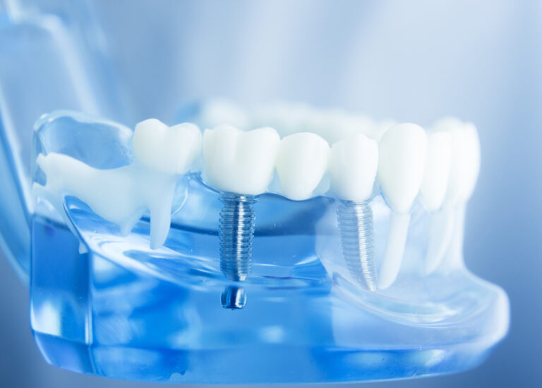 Dental implants