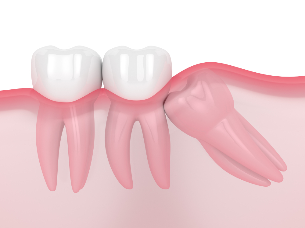 tooth impaction